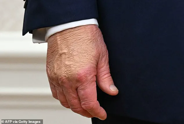 Late-Breaking: White House Reveals Trump's Hand Bruise Was Accident at Davos Event