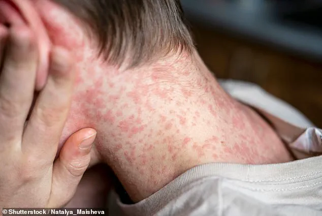 Measles Outbreak at Texas Immigration Detention Center Underlines Public Health Concerns and Regulatory Gaps in Immigration Policy