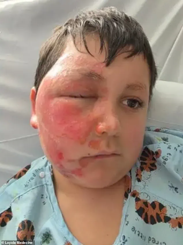 Nine-Year-Old Suffers Severe Burns in TikTok Microwave Trend Involving Needoh Cube