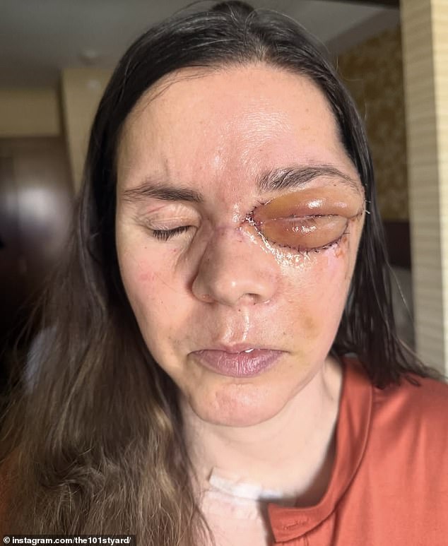 Alaska Mother Survives Bear Attack With Severe Spinal And Brain Injuries