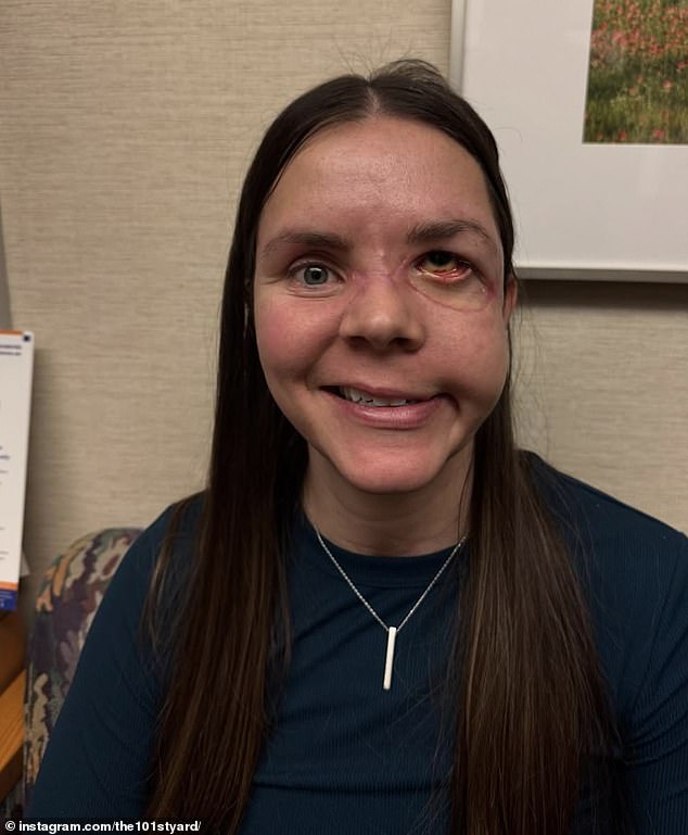 Kenai mother reveals devastating injuries eight months after bear mauling